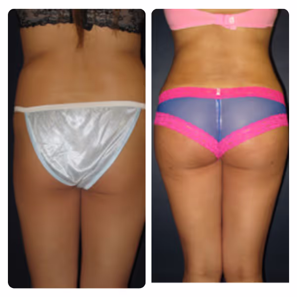 Brazilian Butt Lift (BBL) in Turkey